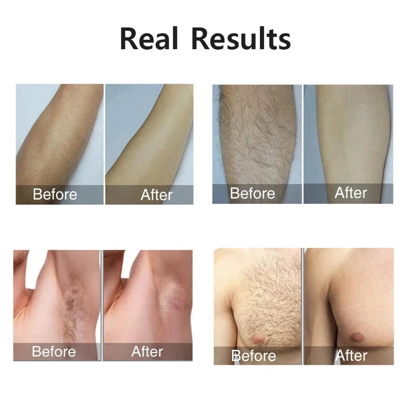 990000 Flashes IPL Laser Epilator, Painless Permanent Hair Removal Device, Facial Body Bikini Shaver for Women